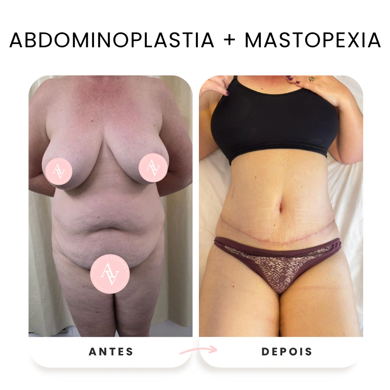 Cirurgias plásticas corporais e faciais antes e depois (2)