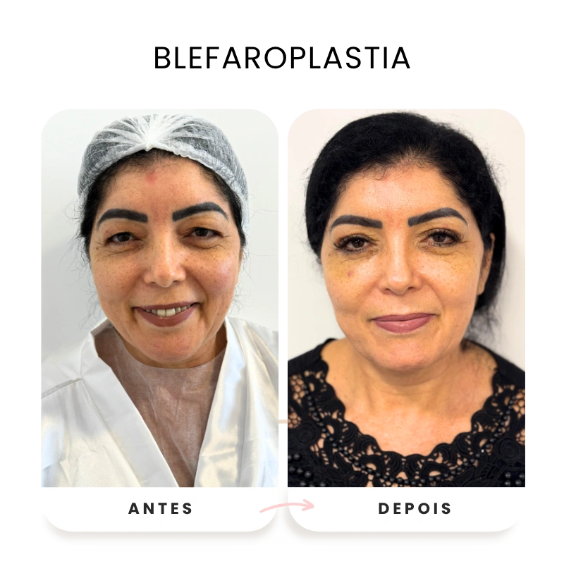 Cirurgias plásticas corporais e faciais antes e depois (3)