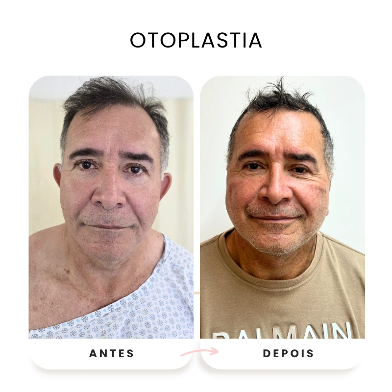 Cirurgias plásticas corporais e faciais antes e depois (4)