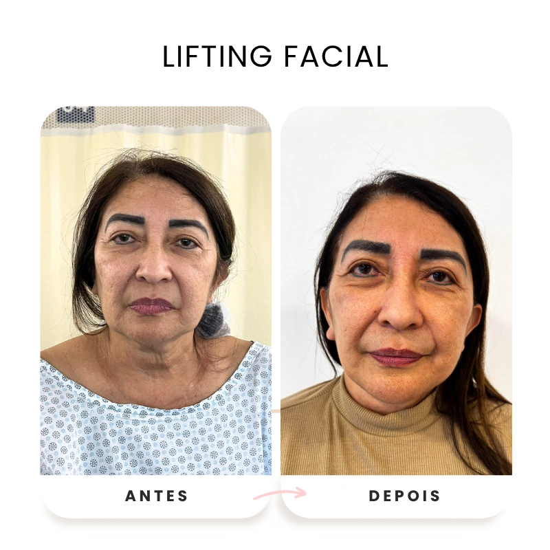 Cirurgias plásticas corporais e faciais antes e depois (5)