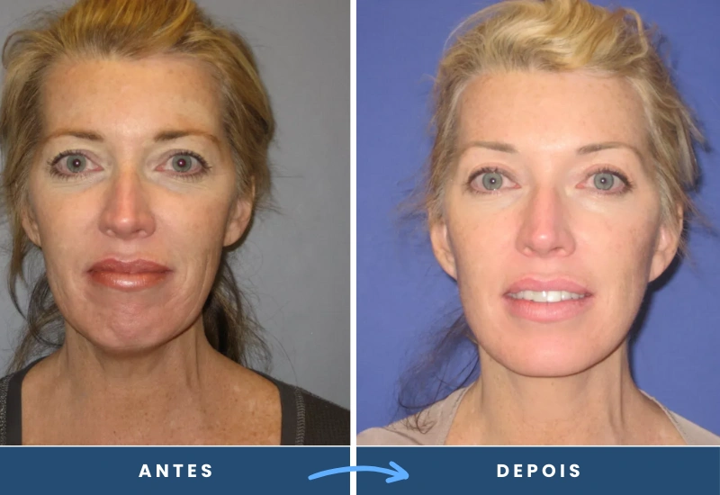 Comparação de antes e depois do mini lifting em mulher, destacando traços mais firmes e suaves. Comparação de antes e depois do mini lifting em mulher, destacando traços mais firmes e suaves.