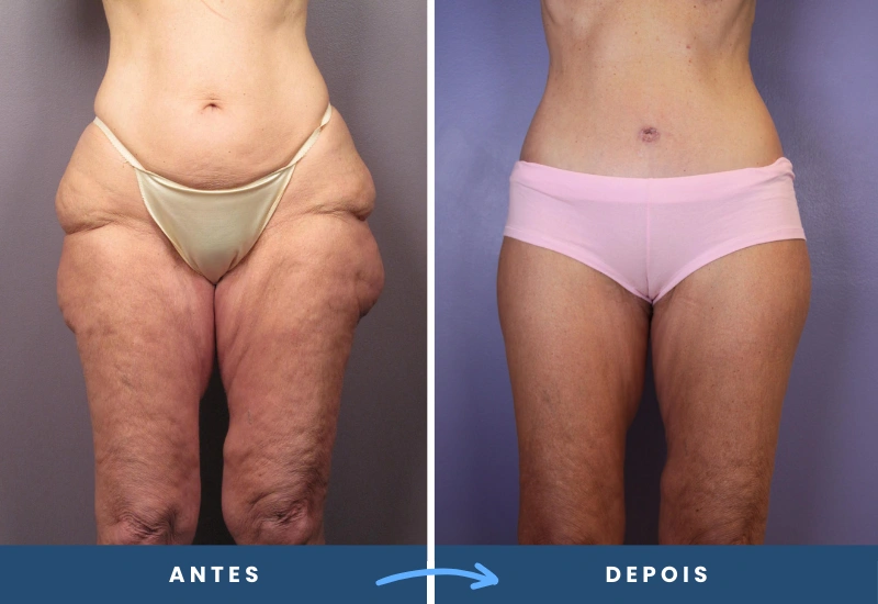 Antes e depois de abdominoplastia em mulher, mostrando transformação significativa no abdômen, realizado em São Bernardo do Campo. Antes e depois de abdominoplastia em mulher, mostrando transformação significativa no abdômen, realizado em São Bernardo do Campo.