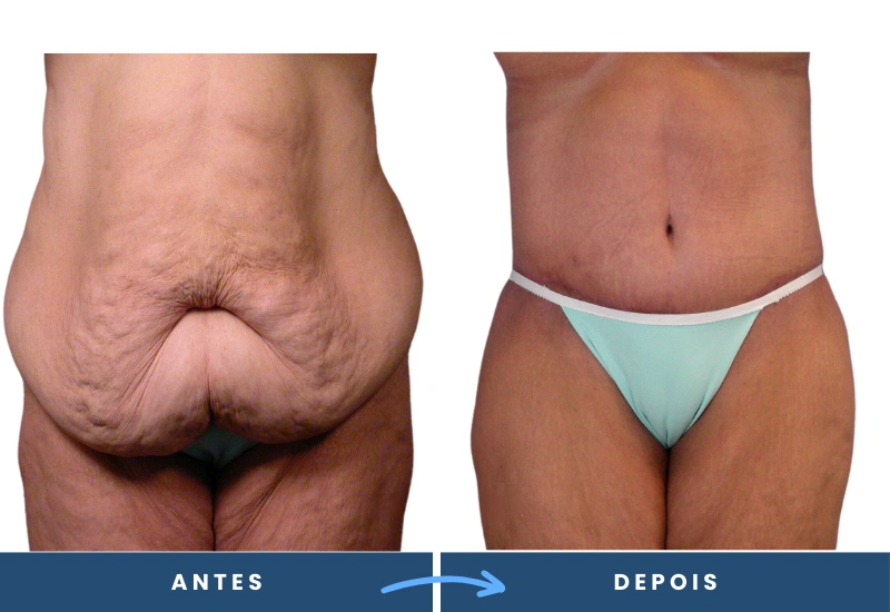 Antes e depois de abdominoplastia em mulher, com abdômen mais tonificado e aparência rejuvenescida, realizado por especialista em São Bernardo do Campo. Antes e depois de abdominoplastia em mulher, com abdômen mais tonificado e aparência rejuvenescida, realizado por especialista em São Bernardo do Campo.