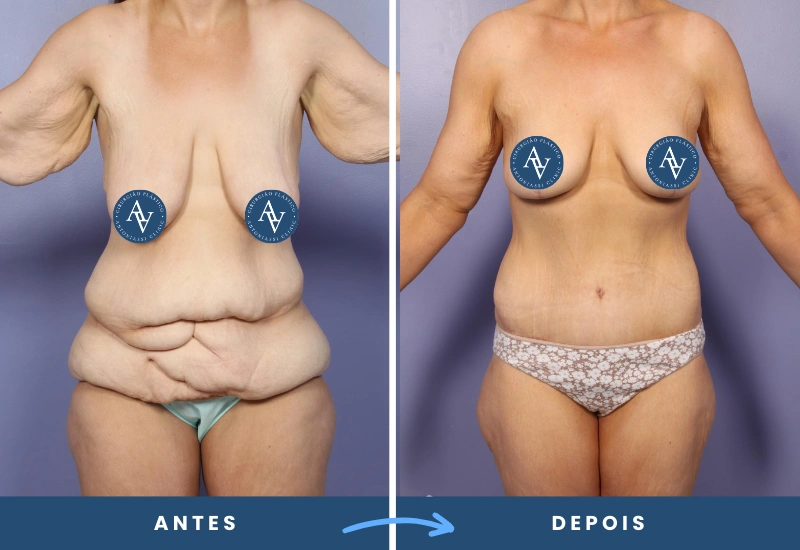 Antes e depois de cirurgia pós-bariátrica em mulher, evidenciando firmeza e redução de pele flácida, realizado por especialista em São Bernardo do Campo. Antes e depois de cirurgia pós-bariátrica em mulher, evidenciando firmeza e redução de pele flácida, realizado por especialista em São Bernardo do Campo.