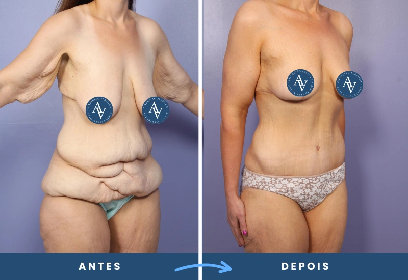 Antes e depois de cirurgia pós-bariátrica em mulher, destacando remoção de excesso de pele e contornos redefinidos, realizado em São Bernardo do Campo.