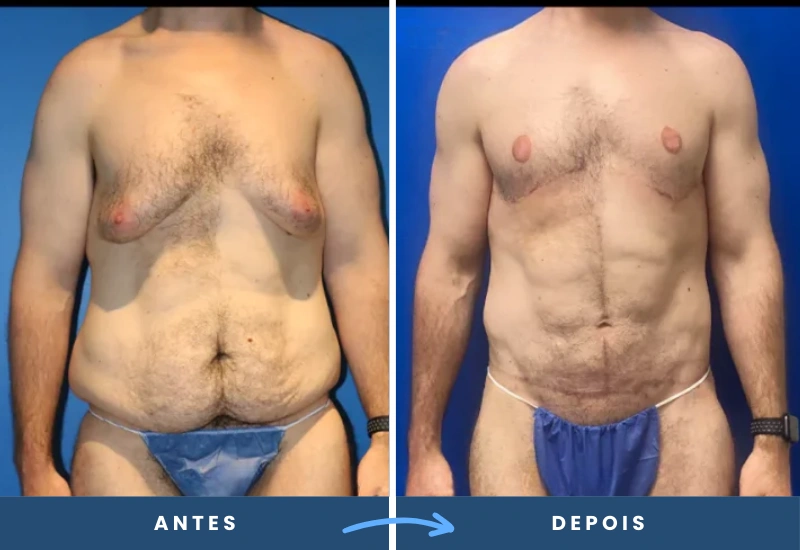 Antes e depois de cirurgia pós-bariátrica em homem, mostrando redução de pele flácida e contornos firmes, realizado em São Bernardo do Campo. Antes e depois de cirurgia pós-bariátrica em homem, mostrando redução de pele flácida e contornos firmes, realizado em São Bernardo do Campo.