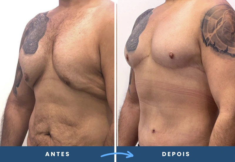 Antes e depois da redução das mamas masculinas, evidenciando um peitoral firme e definido. Antes e depois da redução das mamas masculinas, evidenciando um peitoral firme e definido.