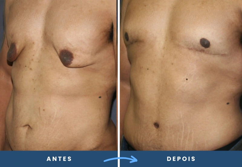 Comparação antes e depois da ginecomastia, com redução significativa do volume das mamas masculinas. Comparação antes e depois da ginecomastia, com redução significativa do volume das mamas masculinas.