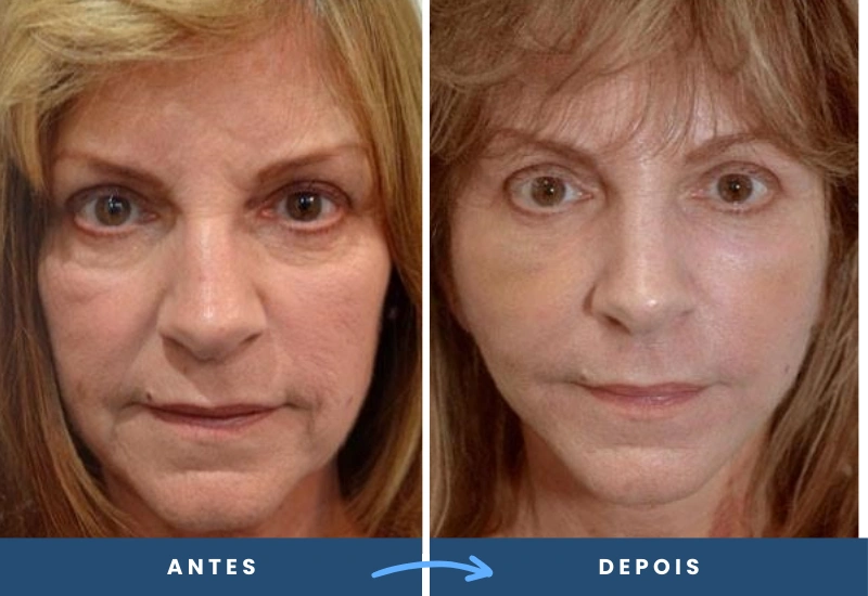 Antes e depois do mini lifting em mulher, com linhas faciais mais definidas e aparência renovada. Antes e depois do mini lifting em mulher, com linhas faciais mais definidas e aparência renovada.