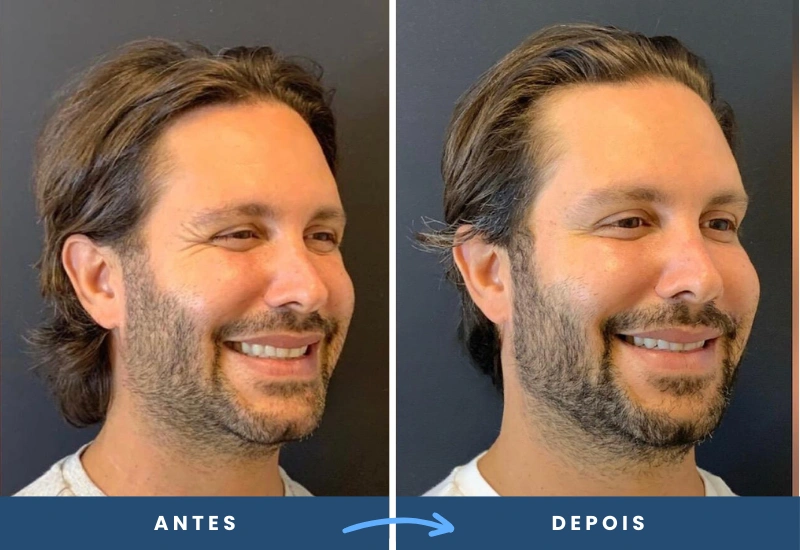 Antes e depois do uso de toxina botulínica no rosto de um homem, suavização das rugas ao sorrir, realizado em São Bernardo do Campo. Antes e depois do uso de toxina botulínica no rosto de um homem, suavização das rugas ao sorrir, realizado a harmonização facial pela Dra Alessandra Peres em São Bernardo do Campo.