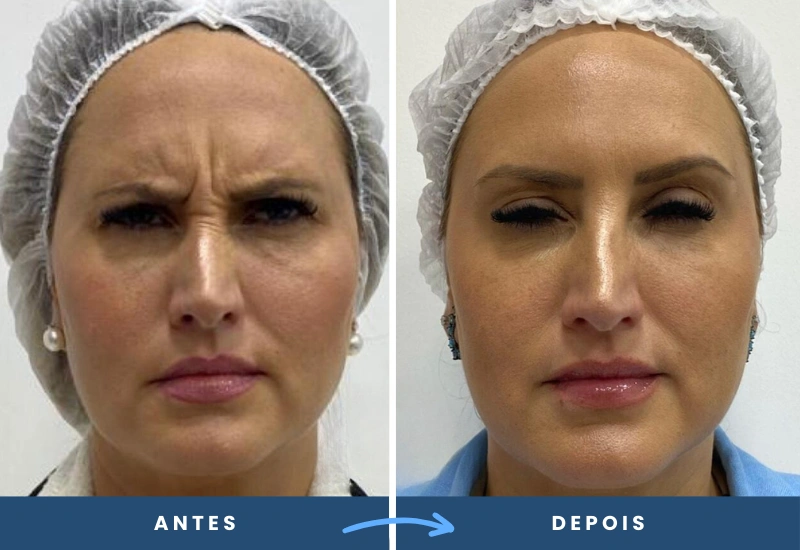 antes e depois de toxina botulínica em mulher, mostrando a redução das rugas de expressão na testa, realizado em São Bernardo do Campo. antes e depois de toxina botulínica em mulher, mostrando a redução das rugas de expressão na testa, realizado em São Bernardo do Campo.