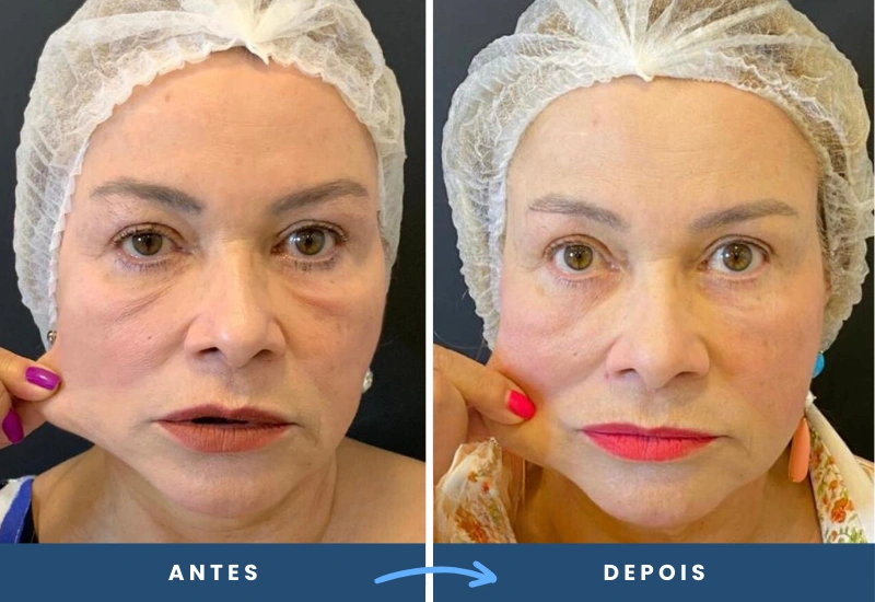 113 Antes e depois de toxina botulínica em mulher, destacando a suavização das linhas de expressão, realizado por especialista em São Bernardo do Campo.