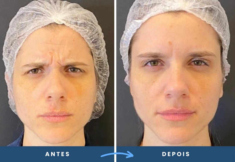 114 Antes e depois de toxina botulínica em mulher, com suavização das linhas entre as sobrancelhas, realizado em São Bernardo do Campo.