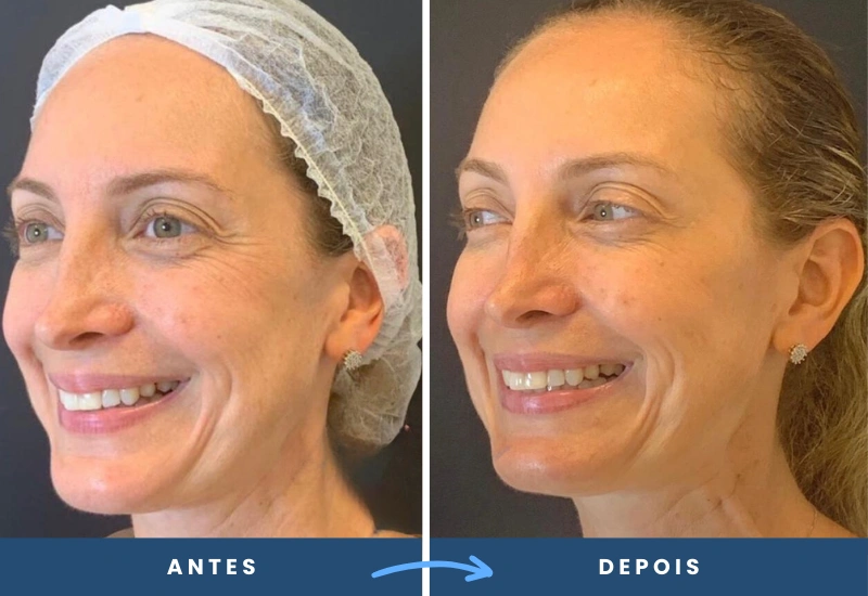 Antes e depois de toxina botulínica em mulher, com rugas reduzidas e rosto mais jovial, realizado em São Bernardo do Campo. Antes e depois de toxina botulínica em mulher, com rugas reduzidas e rosto mais jovial, realizado a harmonização facial pela Dra Alessandra Peres em São Bernardo do Campo.