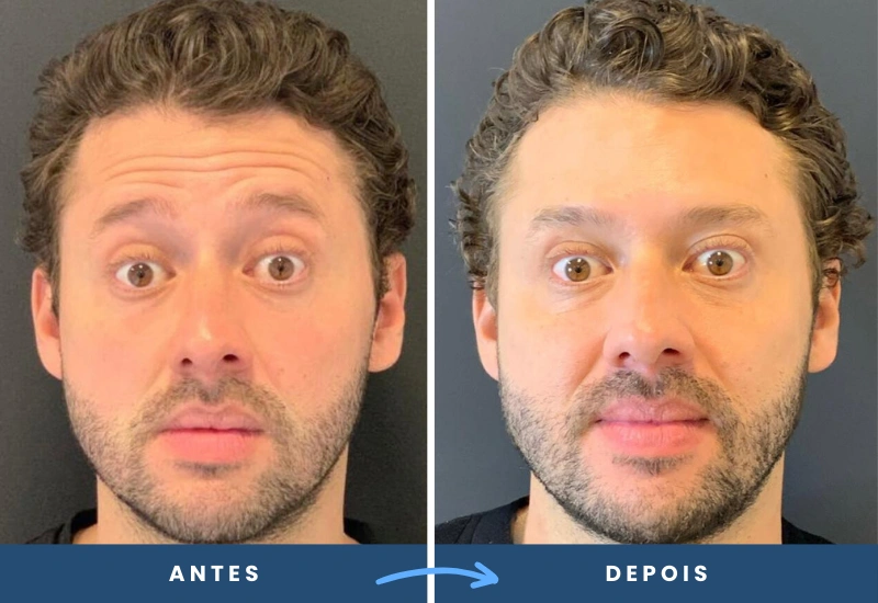 Antes e depois de toxina botulínica em homem, redução das marcas e rugas na testa, realizado em São Bernardo do Campo