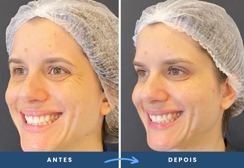 118 Antes e depois de toxina botulínica em mulher, evidenciando a suavização das rugas ao no rosto, realizado em São Bernardo do Campo.