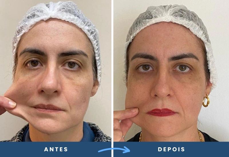 119 Antes e depois de toxina botulínica em mulher, melhorando a elasticidade da pele e acabando com as rugas faciais, realizado em São Bernardo do Campo.