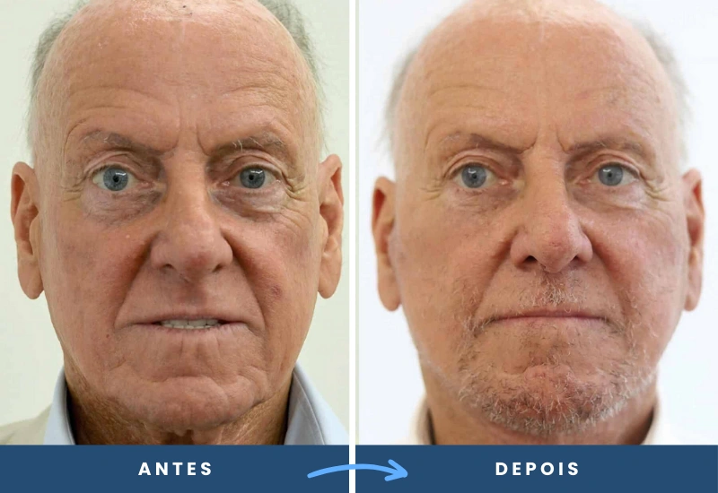 Antes e depois de mini lifting em homem, com traços faciais mais firmes e rejuvenescidos. Antes e depois de mini lifting em homem, com traços faciais mais firmes e rejuvenescidos.