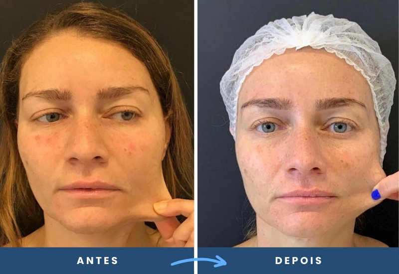 120 Antes e depois de aplicação de toxina botulínica em mulher, evidenciando melhora da firmeza e elasticidade da pele, realizado em São Bernardo do Campo.