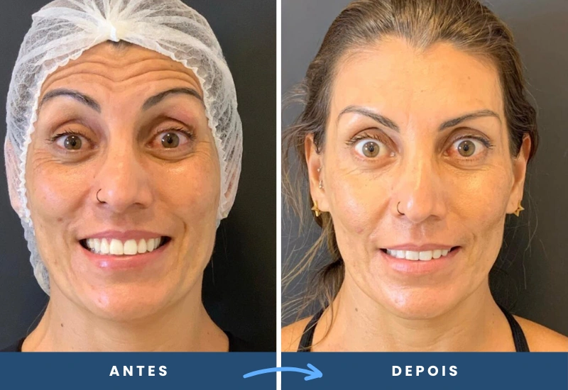 Antes e depois da aplicação de toxina botulínica em mulher, destacando a suavização das rugas na testa e melhora na textura da pele, realizado em São Bernardo do Campo.
