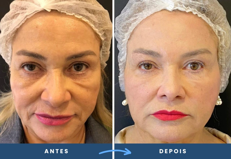 Antes e depois de preenchimento facial em mulher, com redução das linhas de expressão e melhora no volume, realizado em São Bernardo do Campo.