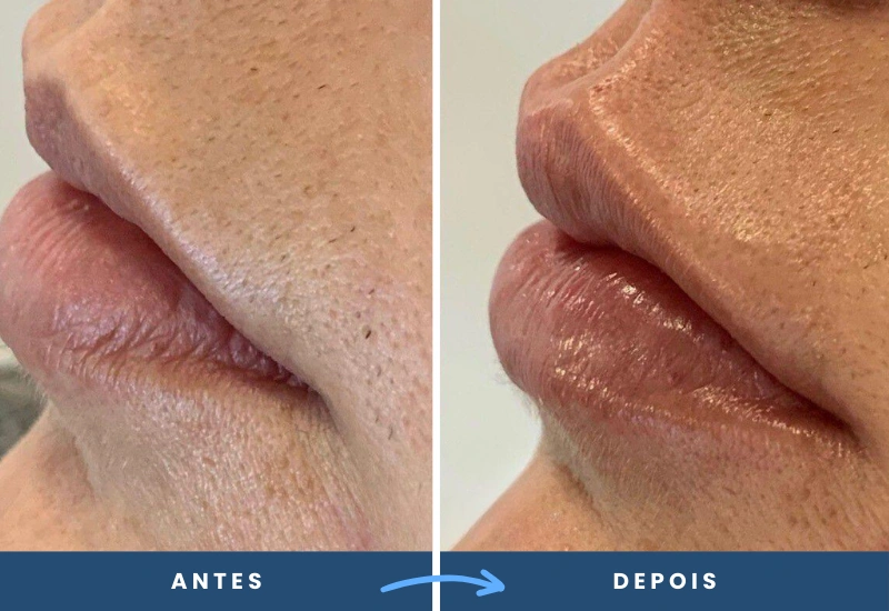 Antes e depois de preenchimento labial, mostrando contornos mais definidos e simetria dos lábios, realizado em São Bernardo do Campo.