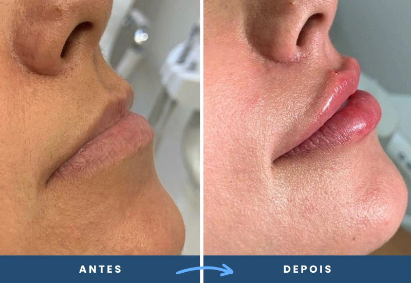 Antes e depois de preenchimento labial, destacando simetria e volume uniforme nos lábios, realizado em São Bernardo do Campo.