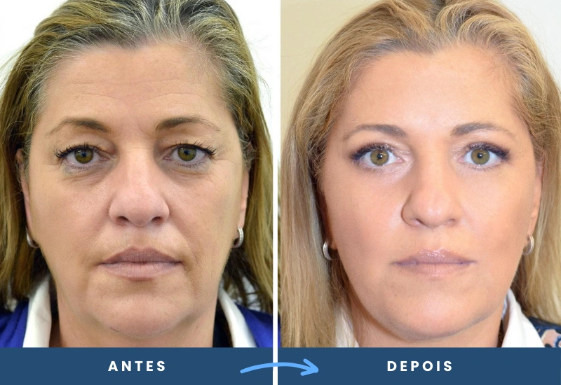 Resultado do mini lifting em mulher, com contornos faciais mais equilibrados e rejuvenescidos. Resultado do mini lifting em mulher, com contornos faciais mais equilibrados e rejuvenescidos, cirurgia plástica feita em são bernardo do campo, pelo cirurgião plástico dr porfirio martinez
