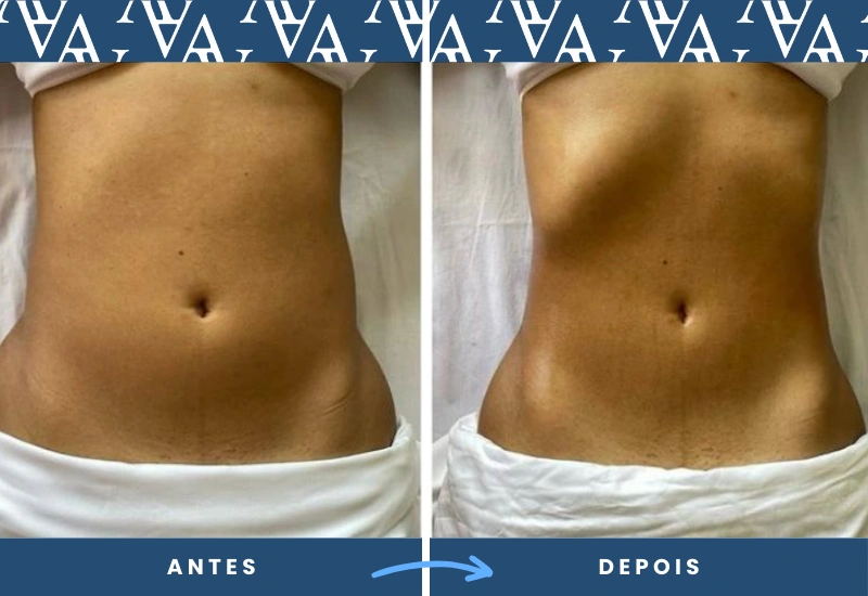 Antes e depois de drenagem linfática, mostrando redução de inchaço e melhora do contorno abdominal, realizado em São Bernardo do Campo. Antes e depois de drenagem linfática, mostrando redução de inchaço e melhora do contorno abdominal, realizado em São Bernardo do Campo.
