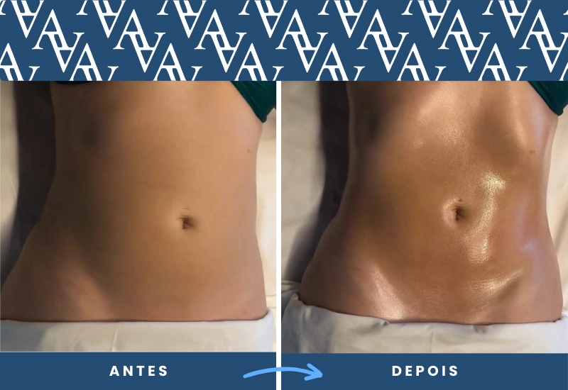 Antes e depois de drenagem linfática, com destaque para redução do inchaço e melhora da silhueta, realizado em São Bernardo do Campo. Antes e depois de drenagem linfática, com destaque para redução do inchaço e melhora da silhueta, realizado em São Bernardo do Campo.