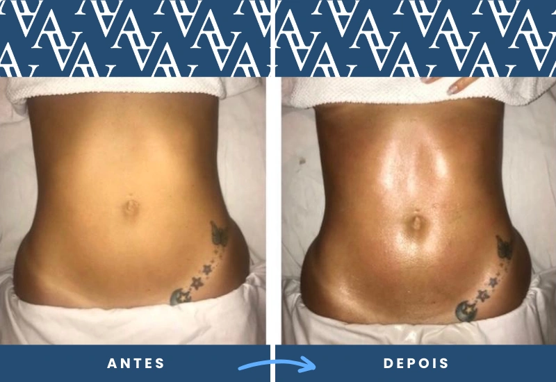 ntes e depois de drenagem linfática, evidenciando melhora na definição e suavização da área abdominal, realizado em São Bernardo do Campo. ntes e depois de drenagem linfática, evidenciando melhora na definição e suavização da área abdominal, realizado em São Bernardo do Campo.