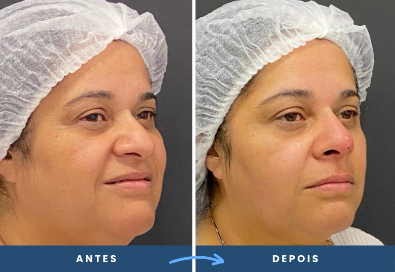 Resultado da rinomodelação, evidenciando um nariz mais simétrico e proporcional ao rosto.