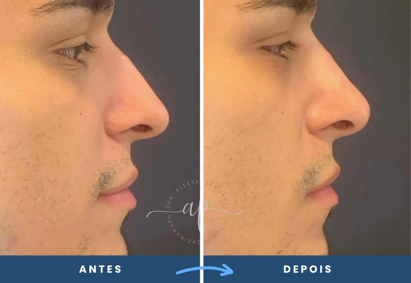 Antes e depois da rinomodelação, destacando melhorias no perfil nasal e harmonia estética Antes e depois da rinomodelação, destacando melhorias no perfil nasal e harmonia estética