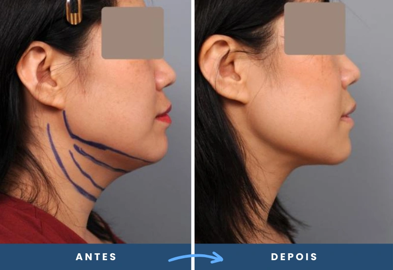Resultado de lipólise submandibular, evidenciando a melhora no contorno do queixo e da mandíbula