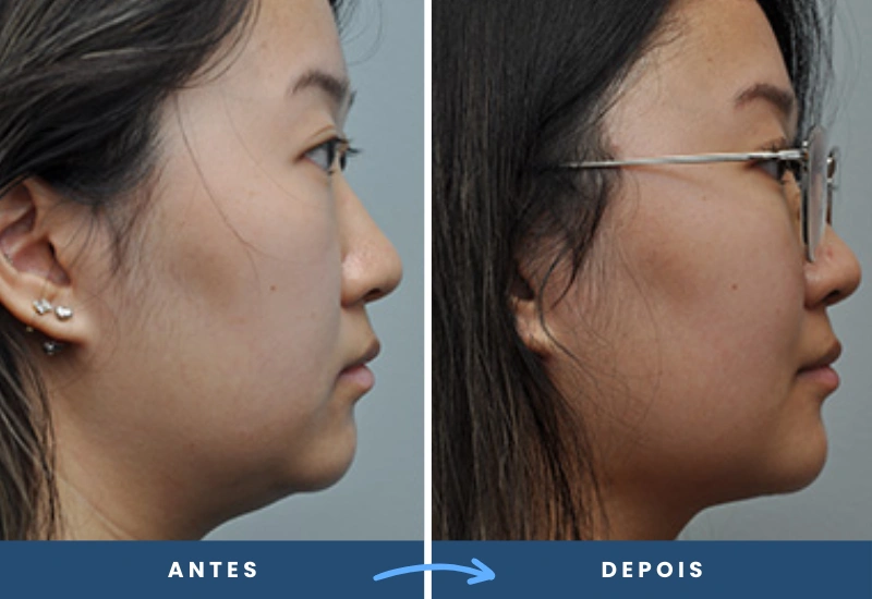 Antes e depois de uma paciente após procedimento na papada, com contorno facial visivelmente mais fino. Antes e depois de uma paciente após procedimento na papada, com contorno facial visivelmente mais fino.