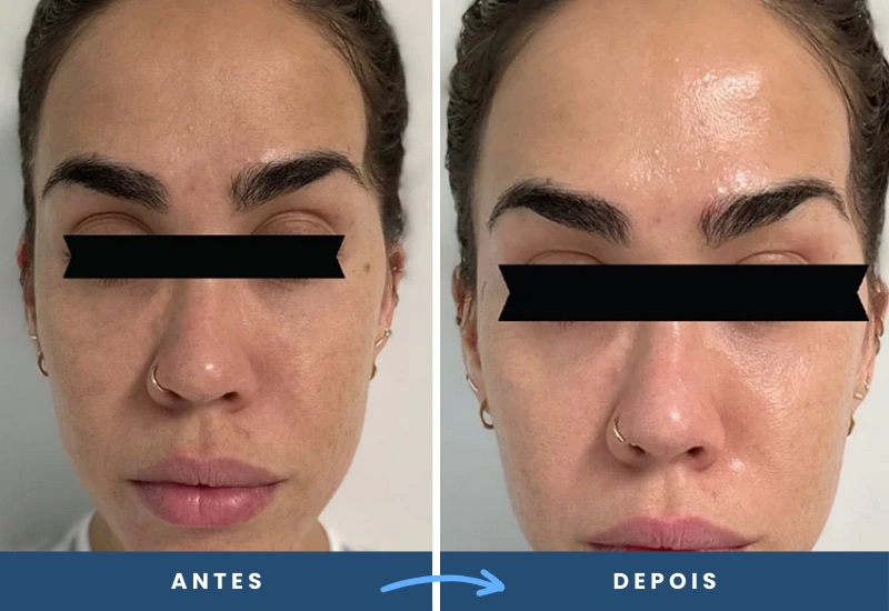 Antes e depois do microagulhamento com drug delivery, evidenciando pele renovada e estímulo de colágeno, realizado em São Bernardo do Campo.