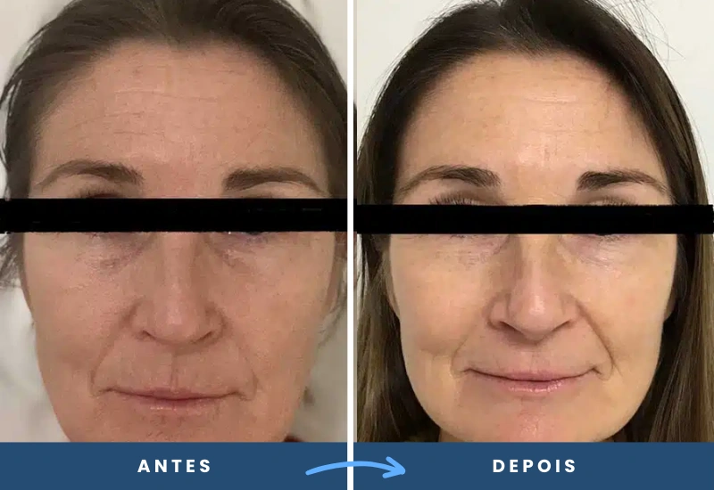 Antes e depois do microagulhamento com drug delivery, mostrando pele mais uniforme e com menos marcas, realizado em São Bernardo do Campo. Antes e depois do microagulhamento com drug delivery, mostrando pele mais uniforme e com menos marcas, realizado em São Bernardo do Campo.