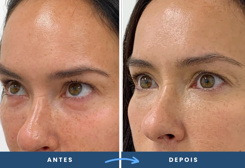 Comparação de antes e depois do microagulhamento, destacando firmeza e viço facial com estímulo de colágeno. Comparação de antes e depois do microagulhamento, destacando firmeza e viço facial com estímulo de colágeno.