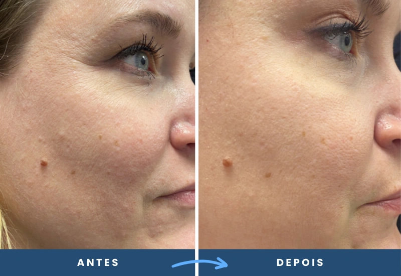 Resultado do microagulhamento facial com drug delivery, destacando a textura mais uniforme e luminosa da pele. Resultado do microagulhamento facial com drug delivery, destacando a textura mais uniforme e luminosa da pele.