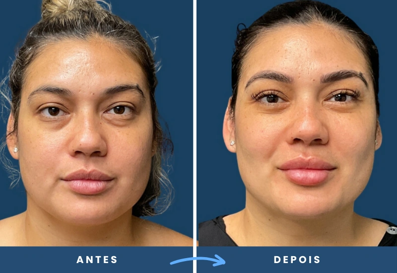 Comparação de antes e depois de bichectomia em mulher, com redução de volume nas bochechas, realizada por cirurgião plástico em São Bernardo do Campo.