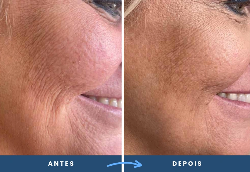 Antes e depois do tratamento Skinbooster, evidenciando a suavização de rugas ao redor dos olhos e bochechas.