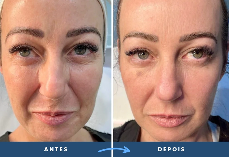 Antes e depois do tratamento com Skinbooster, mostrando redução de rugas e aspecto rejuvenescido no rosto.