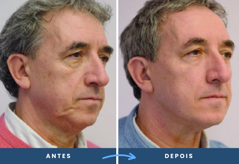 Resultado do procedimento com fios de PDO e Sutura Silhouette, evidenciando pele mais firme e contornos rejuvenescidos realizada pela Dra Alessandra Peres em São Bernardo do Campo.
