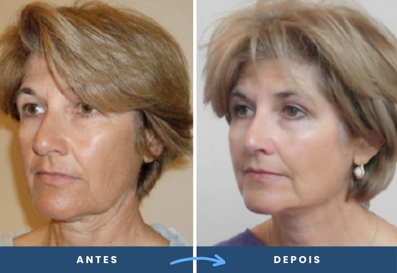 Antes e depois dos fios de PDO em homem, destacando firmeza e rejuvenescimento no contorno facial. Antes e depois dos fios de PDO em homem, destacando firmeza e rejuvenescimento no contorno facial.