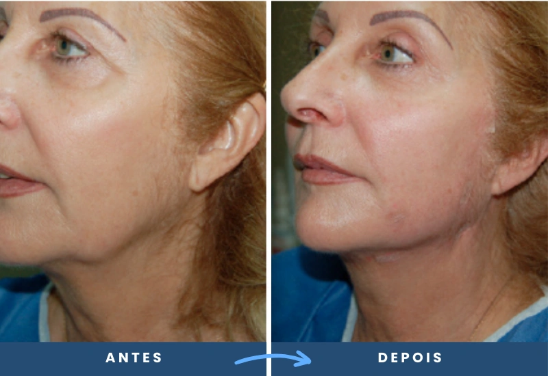 Comparação de antes e depois do procedimento com Sutura Silhouette em mulher, mostrando firmeza e elevação da pele. Comparação de antes e depois do procedimento com Sutura Silhouette em mulher, mostrando firmeza e elevação da pele.