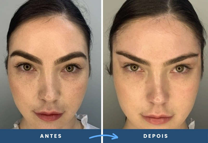 Resultado do procedimento Fox Eyes em mulher, destacando olhar mais alongado e elevado, realizado em São Bernardo do Campo.