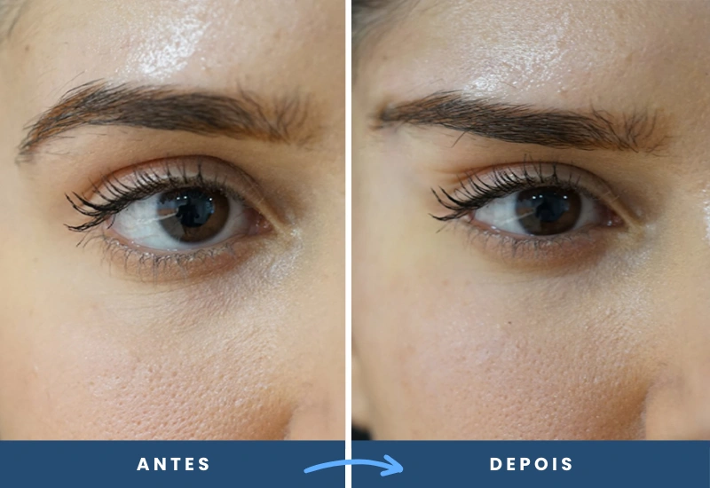 Antes e depois do procedimento Fox Eyes em mulher, evidenciando um olhar mais aberto e expressivo, realizado em São Bernardo do Campo. Antes e depois do procedimento Fox Eyes em mulher, evidenciando um olhar mais aberto e expressivo, realizado em São Bernardo do Campo.