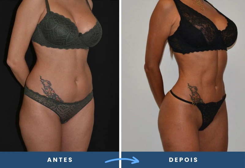 Resultado da lipoaspiração de alta definição em mulher, com contornos abdominais mais definidos e silhueta esculpida, realizada em São Bernardo do Campo. Resultado da lipoaspiração de alta definição em mulher, com contornos abdominais mais definidos e silhueta esculpida, realizada em São Bernardo do Campo.