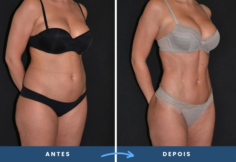 Antes e depois da cirurgia corporal lipoaspiração de alta definição em mulher, destacando cintura fina e curvas naturais, realizada em São Bernardo do Campo.