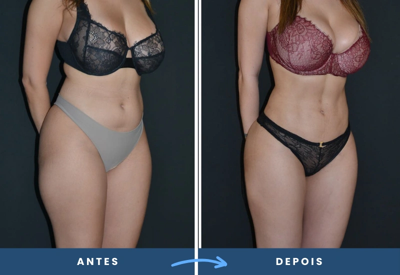 Comparação de antes e depois de lipoescultura HD, destacando a cintura mais fina e curvas mais definidas. Comparação de antes e depois de lipoescultura HD, destacando a cintura mais fina e curvas mais definidas.